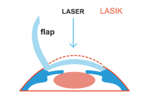 Explain how laser find application in eye surgery